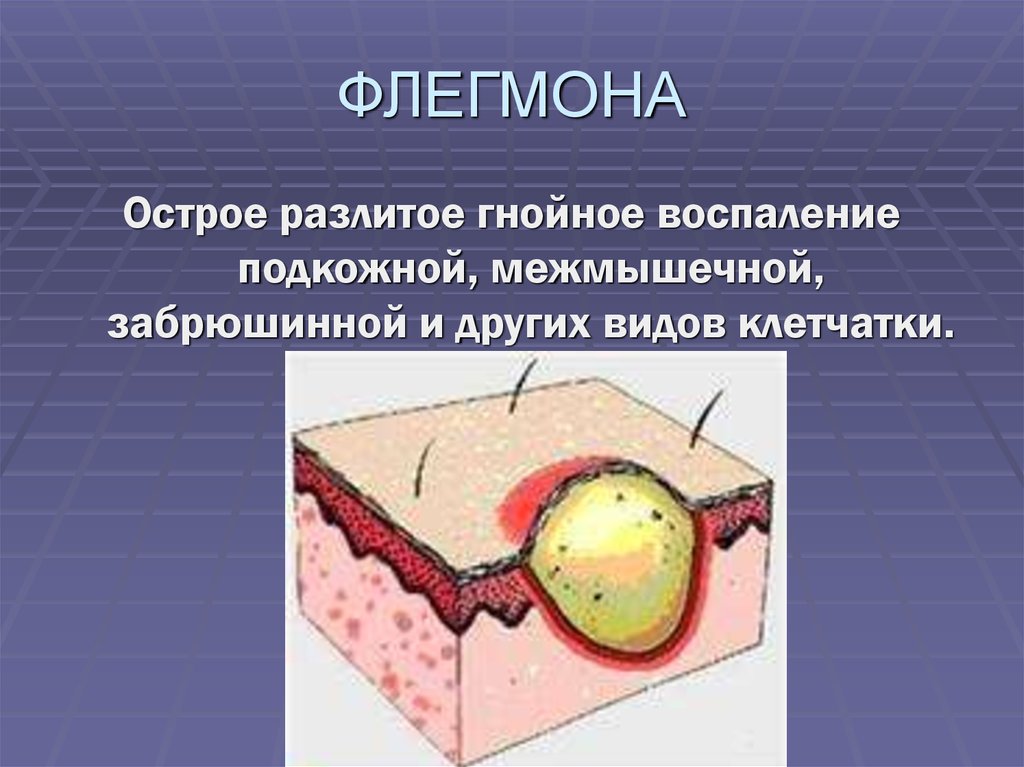 Лечение флегмоны: операция, лекарства и дополнительные методы