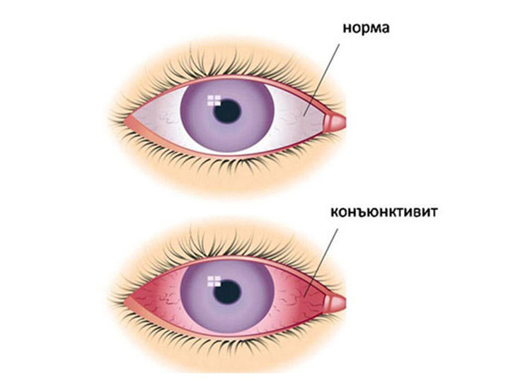 подходит для лечения конъюнктивита 